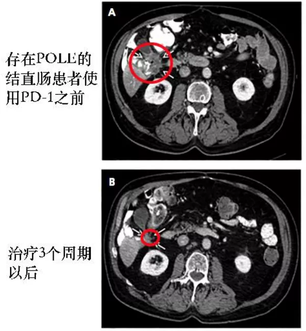 天文|基因检测预测免疫治疗疗效，这些基因让你越治越糟糕