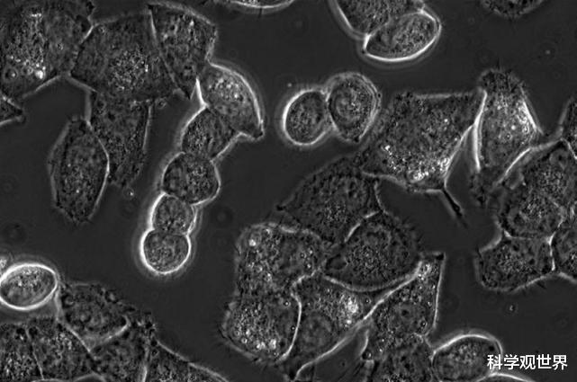 癌细胞 癌症会传染吗？疯狂科学家曾向健康人体注入癌细胞后，得到了答案