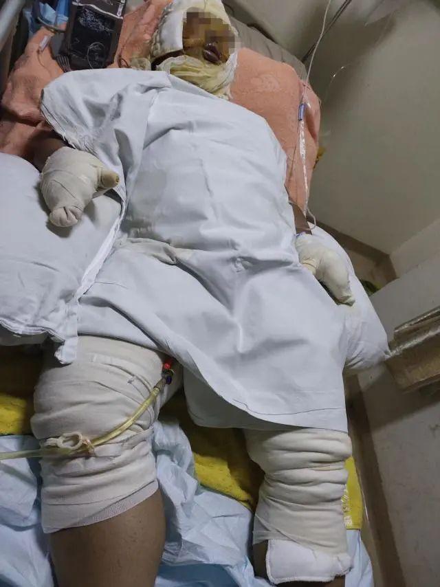 新兴火山 祸从天降，男子找工作时上厕所遭遇爆炸，救护车上还念叨着两件事