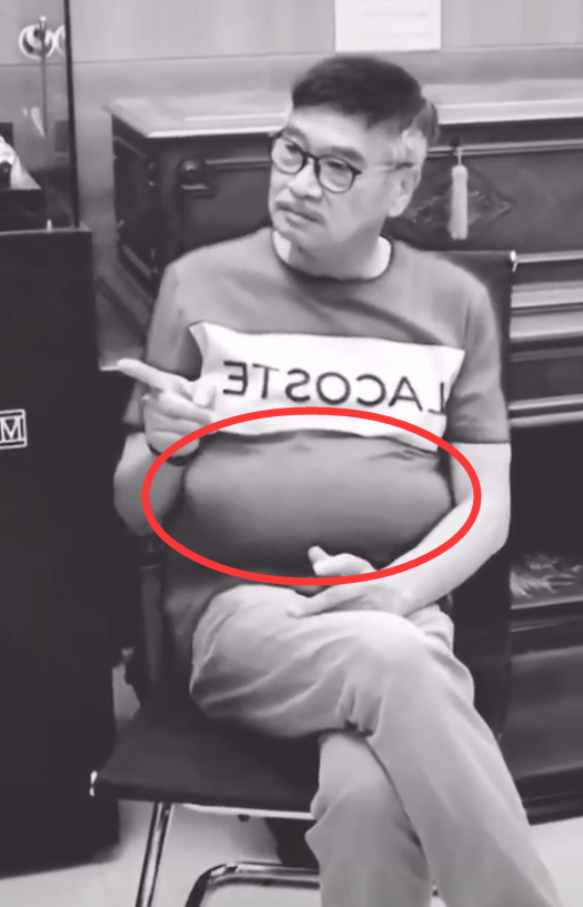 吴孟达|粉丝公开吴孟达肝癌晚期照片，肝腹积水非常严重，肚子大的像吹起来的气球