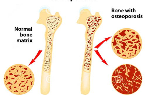 水果|骨丢失不能吃荔枝？医生提示：若想稳定骨量，2水果或可常吃