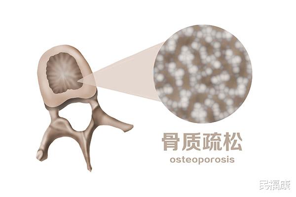 骨質疏松|骨質疏松是老年人的專屬病？學會自測骨骼問題，為健康加“骨”勁