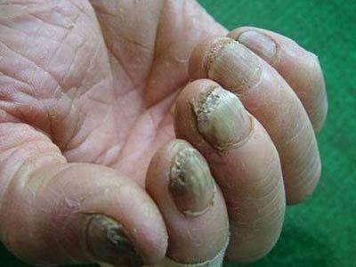 清源净流|灰指甲增厚萎缩分离怎么办！每天涂点它，7天重获亮甲！