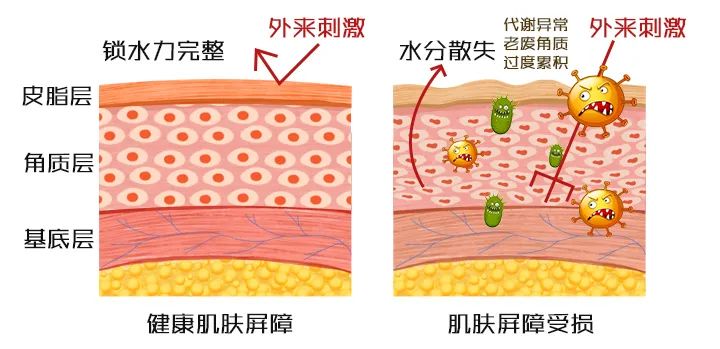湿疹|湿疹，一种治不好但却让人恨得牙痒痒的病。