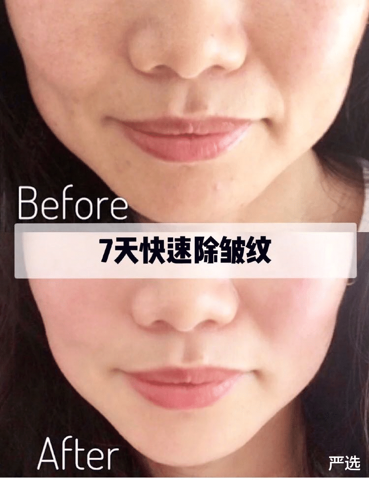 严选|为抗老注射“玻尿酸”变面瘫的女人,现在啥样?过来人:追悔莫及