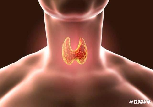 甲状腺结节|转告家人:查出甲状腺结节,宁愿挨饿也别碰“3物”,建议忌口