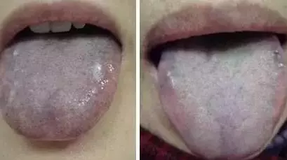 山楂|舌苔辨识9种中医体质，有配图！