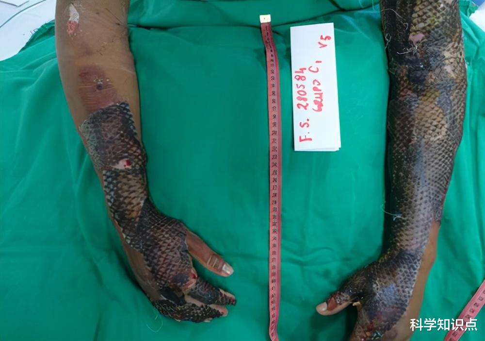 卓越|口碑逆转的入侵生物?不算好吃的罗非鱼,在烧伤领域却有卓越表现