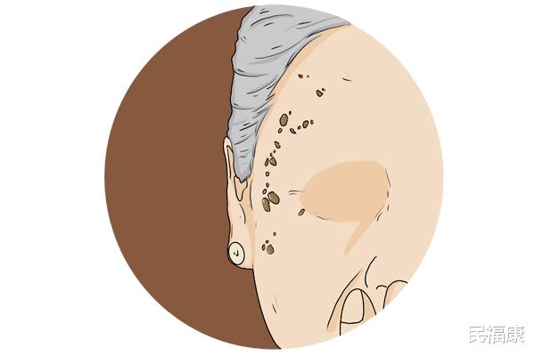 老年斑|生长老年斑，与什么原因有关？为啥有人年龄大了，却不见老年斑？