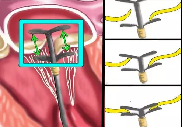 失眠|心脏里的“阀门”关不严，怎么办？