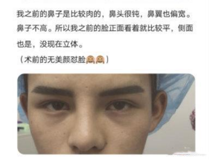 迪丽热巴|殷世航自曝整容，看清未整前的照片后：幸亏整的早