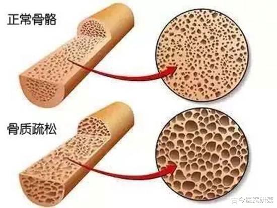 骨科|吃一口等于5斤味精,骨科专家:人们还在无知的往嘴里送,骨头迟早“嘎嘣脆”