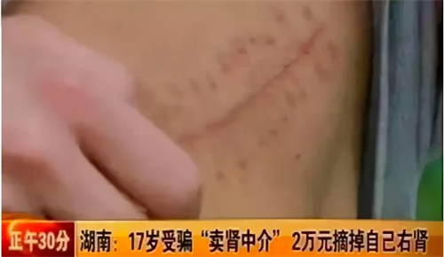 2011年,17岁湖南小伙去黑诊所卖肾买手机,获赔147万却葬送人生