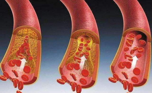 运动|血脂升高的主要原因与盐无关？医生提醒：“1酸”少往嘴里送