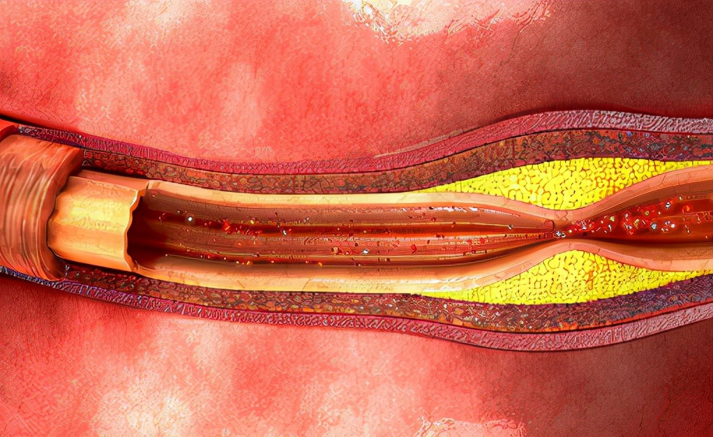 医线天|为何“高血脂”越来越多?提醒:4件事尽早远离,保护血管