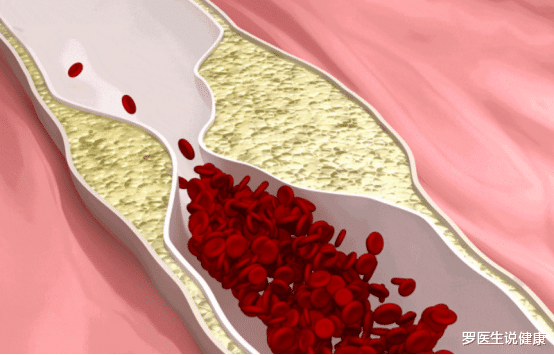 罗医生说健康|血脂高不可以吃蔬菜？提醒：这3种食物或是“升脂大户”，别再贪吃