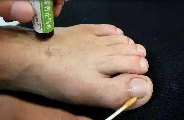 黎青努力中|碘伏治疗灰指甲成功了是怎么回事？一线专家从三方面解释灰甲有效治疗原理！