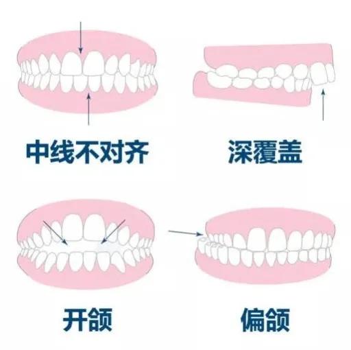 小美说美|怎么判断自己用不用矫正牙齿？
