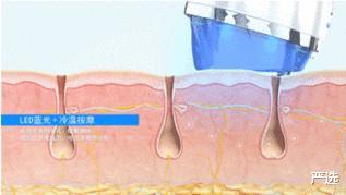 美容仪|女子为变美“不择手段”，脸上埋下百根“金丝”，现在怎样了？