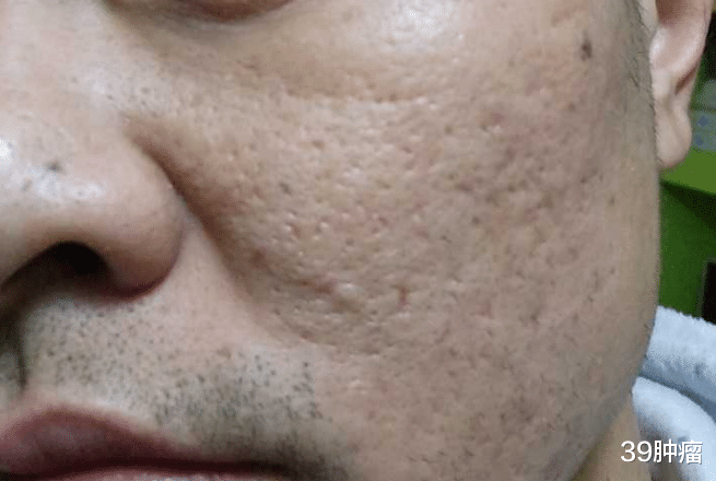 39肿瘤|男子误认为防晒不当，1个月后确诊肺癌！医生：身体2处发黑，趁早检查