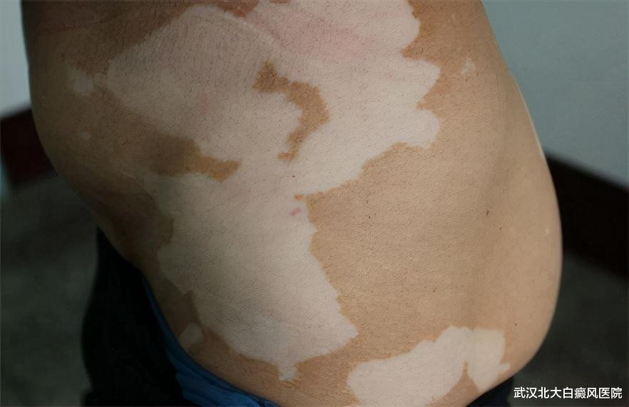 白癜风|预防白癜风扩散“力不从心”,这些扩散征兆你要知道?