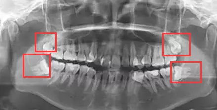 运动|智齿到底要不要拔？你该做决定了！