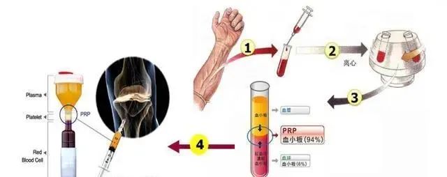 关节炎|世界关节炎日|一起来扒一扒关节炎的二三事吧