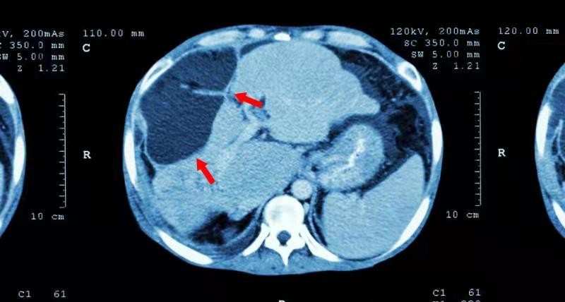 肝脏|多家医院联合声明：停止食用“1调料”，或在慢慢“掏空”你的肝脏