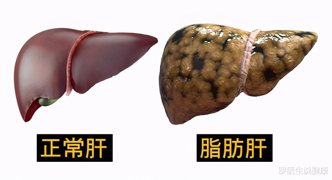 罗医生说健康|脂肪肝就是胖子的“专利”，瘦的人可否高枕无忧？