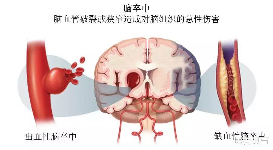 高圆圆 脑梗死预防大于治疗！医生坦言注意几点就可轻松预防
