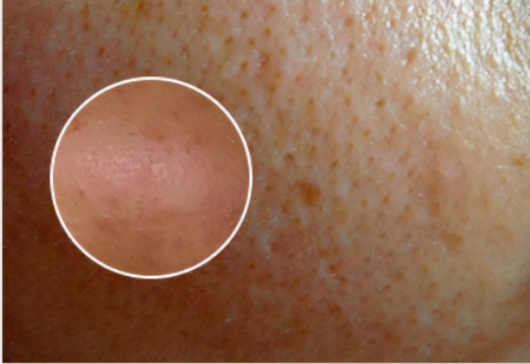 运动|“毛孔粗大”怎么改善?看这篇就够了