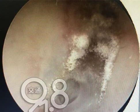 城市的时代 男子常掏耳朵，不料可怕一幕出现：里面竟长满密密麻麻的……