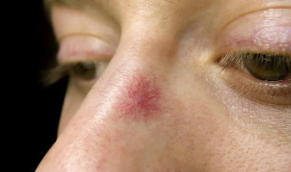 肝癌|小伙每天大便5-6次，查出肝癌，医生直言：身体3处异常，早查CT