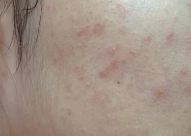 杏鲍菇|脸上很多小颗粒，咋回事？