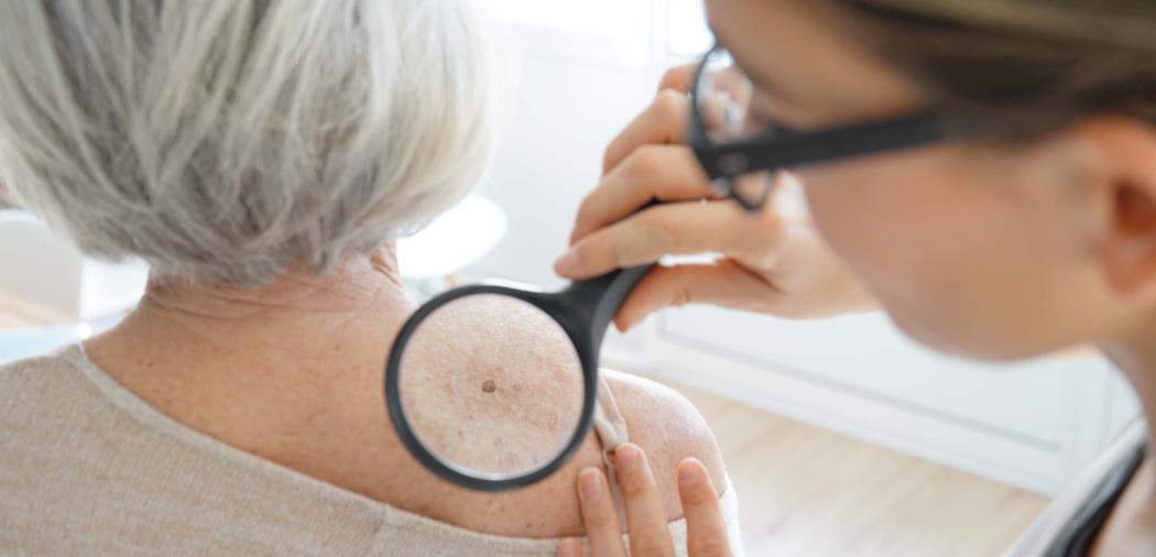 黑色素瘤 Science重磅：科学家找到癌症发生源头，治愈肿瘤有了新思路