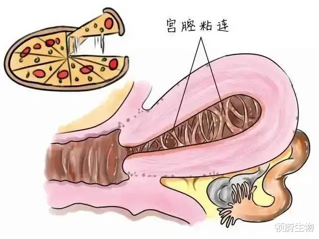 航天员 干细胞治疗中重度宫腔粘连，使患者成功受孕