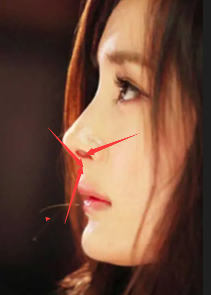 整容|内娱“假鼻子”大PK，谁的假到逆天，谁的越整越残？