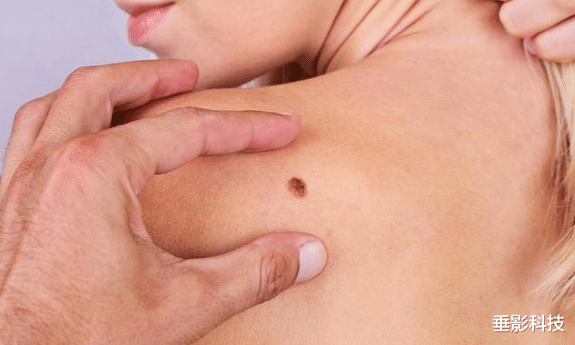 肝脏|医生提醒:身上长出这2种“小红点”,可能是肝在求救,别大意了