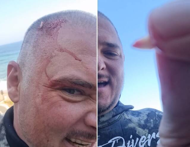铁蛋趣闻 南非男子潜水被鲨鱼袭击，上岸头顶插着鲨鱼牙齿
