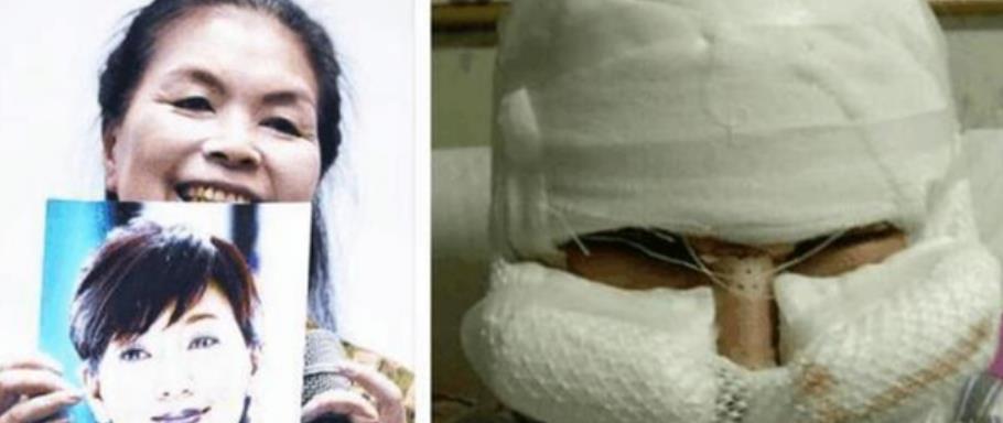 整容|6旬大妈想变赵雅芝,花200万整容10次,看到前后对比照众人笑疯