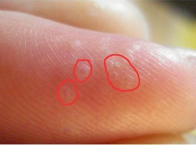 看大医|手上长这种透明“小水泡”，以为是上火？错，或是湿气过重发出的“暗示”