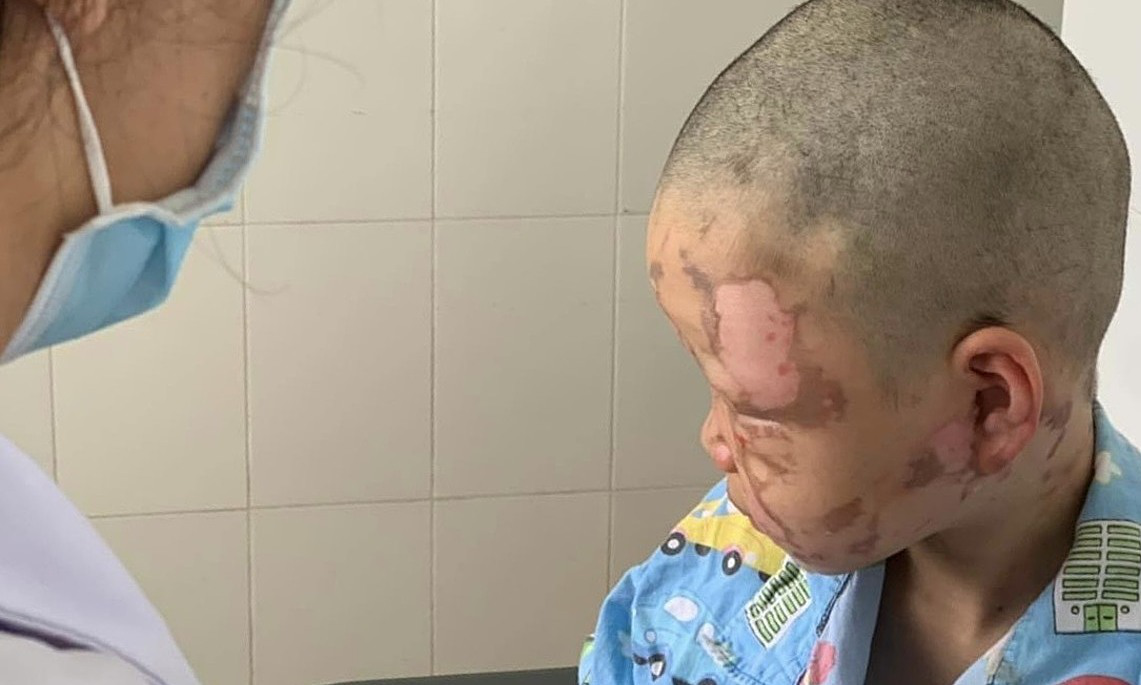 民生播报 10岁男孩在家中玩酒精，意外将面部灼伤，现病情虽稳定却仍有疤痕