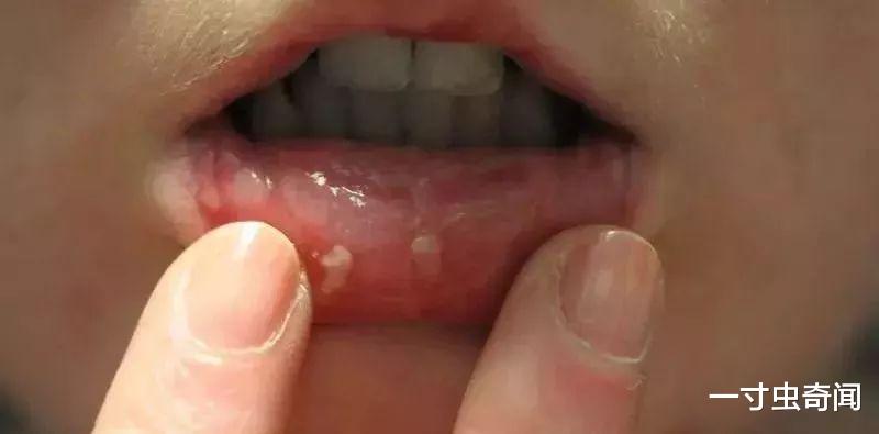 一寸虫奇闻|毒果肆虐:广电总局禁播槟榔广告,近亿人嚼食的槟榔,有何危害?