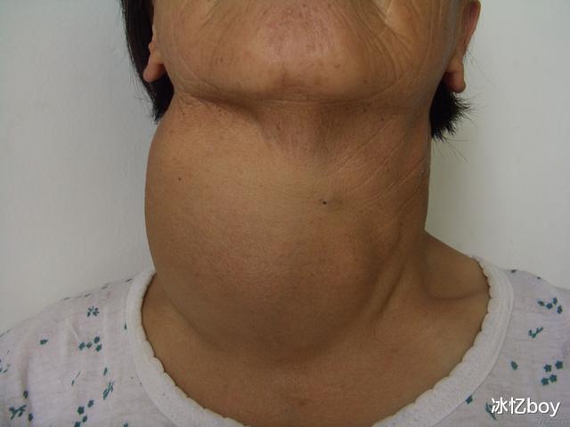 饮食|甲状腺结节的“软化剂”早已公布，不是丝瓜，可劲吃或能改善结节