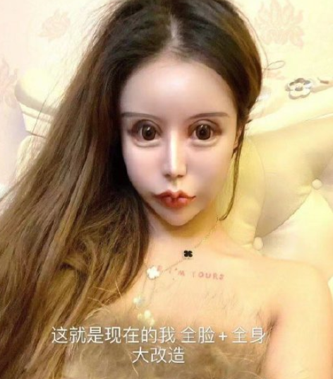 整容|13岁起全脸整容的她，咋样了？