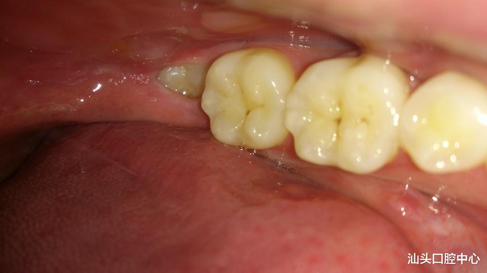 汕头口腔中心|智齿发炎了肿痛要拔掉吗？听听专家怎么说