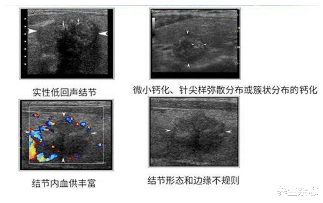 养生杂志|吃一次胜过8斤牡蛎，乳腺科专家提醒：乳腺结节的人不妨多吃，消肿散结