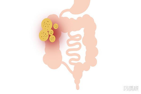细菌感染|肚脐眼中的“黑泥”是什么?用手抠掉,可以吗?