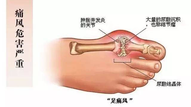 柚子医生 痛风“重男轻女”，尿酸高出现这些症状，男性要注意！