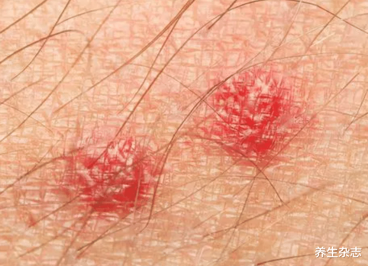 宫颈癌|腿是宫颈“信号灯”，腿上若出现这4种异常现象，或是在提示有HPV了